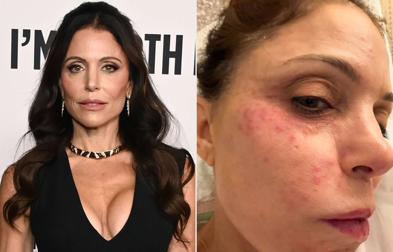 Bethenny Frankel explains why she will never use hotel towels or sheets again after infection.